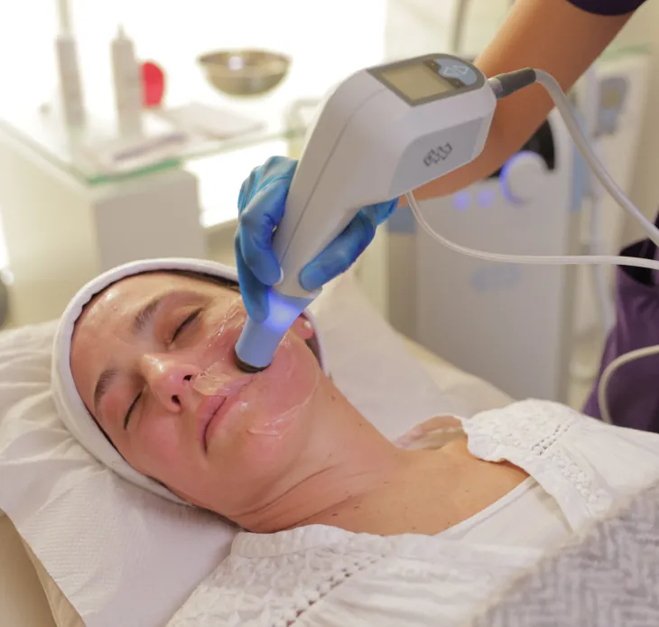 Tratamiento EXILIS FACIAL 360
