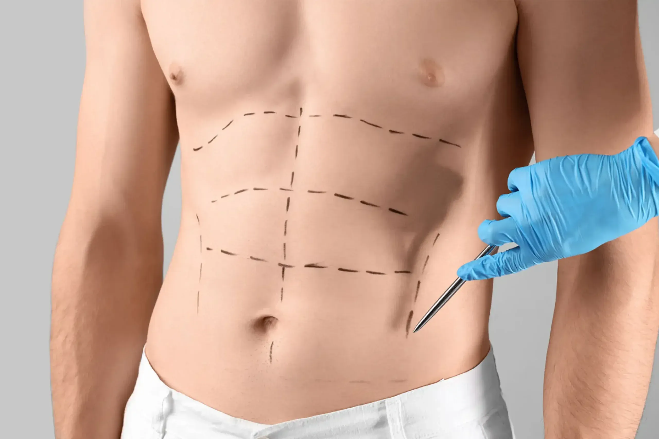 Lipoescultura sin cirugía en hombres: guía clara y confiable
